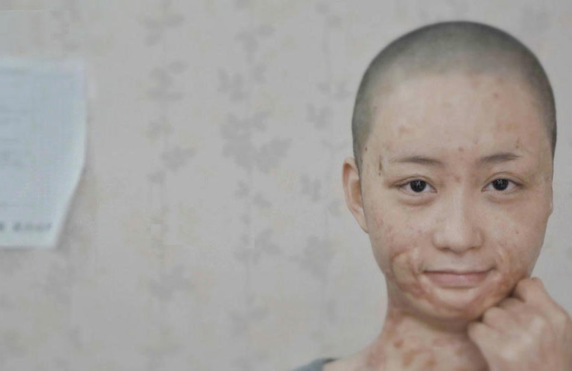 被官二代毁容少女索赔360余万元 在北京坐地铁被看哭