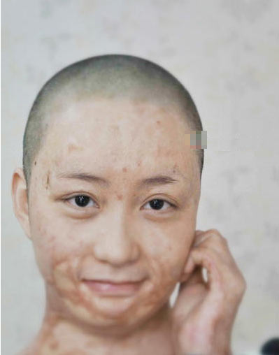 被官二代毁容少女索赔360余万元 在北京坐地铁被看哭