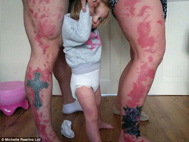 女儿腿上有巨大胎记 父母纹同意花纹