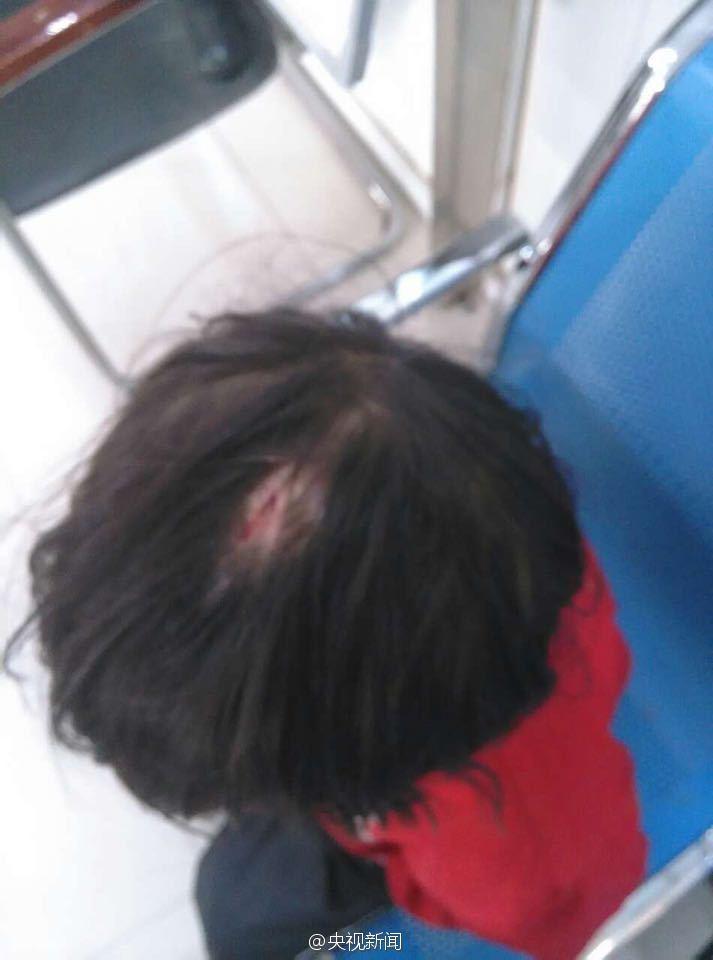 安徽11岁女孩被母亲毒打 头部遭锐器重击