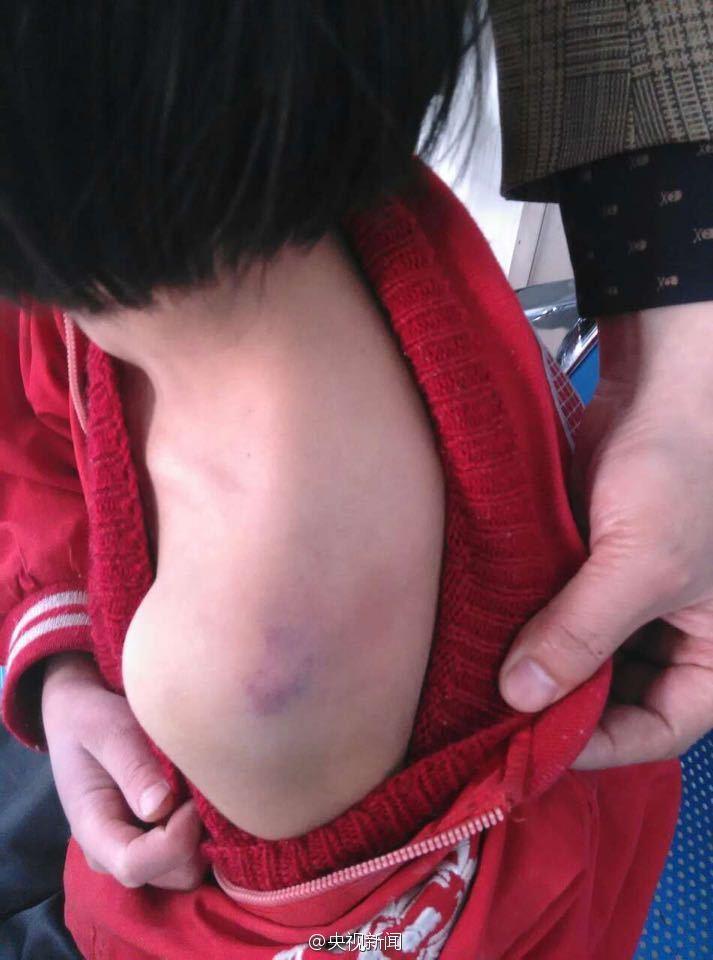 安徽11岁女孩被母亲毒打 头部遭锐器重击