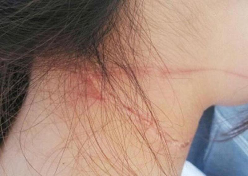 江苏扬州女子骑车时遭风筝线“割伤”脖子