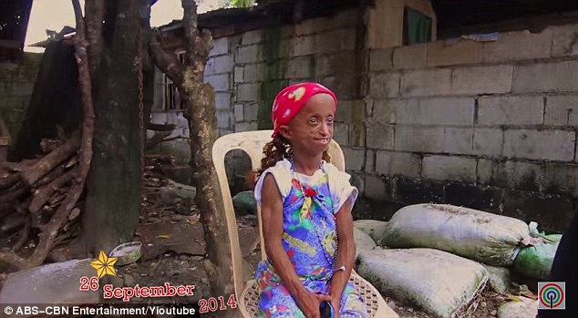 菲律宾年纪最大早衰女孩庆祝18岁生日