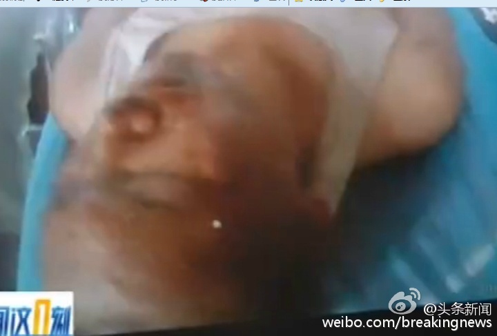 天津爆炸获救消防战士面部烧伤严重 部分失忆