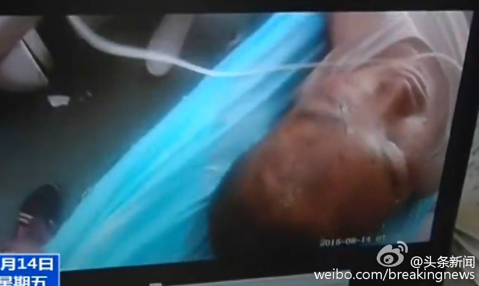 天津爆炸获救消防战士面部烧伤严重 部分失忆
