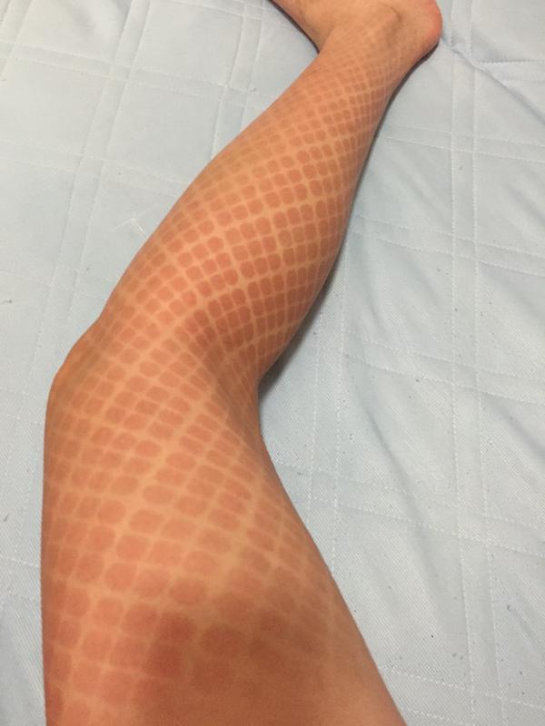 女生扮“弥海砂”一整天 双腿被晒出鱼鳞痕