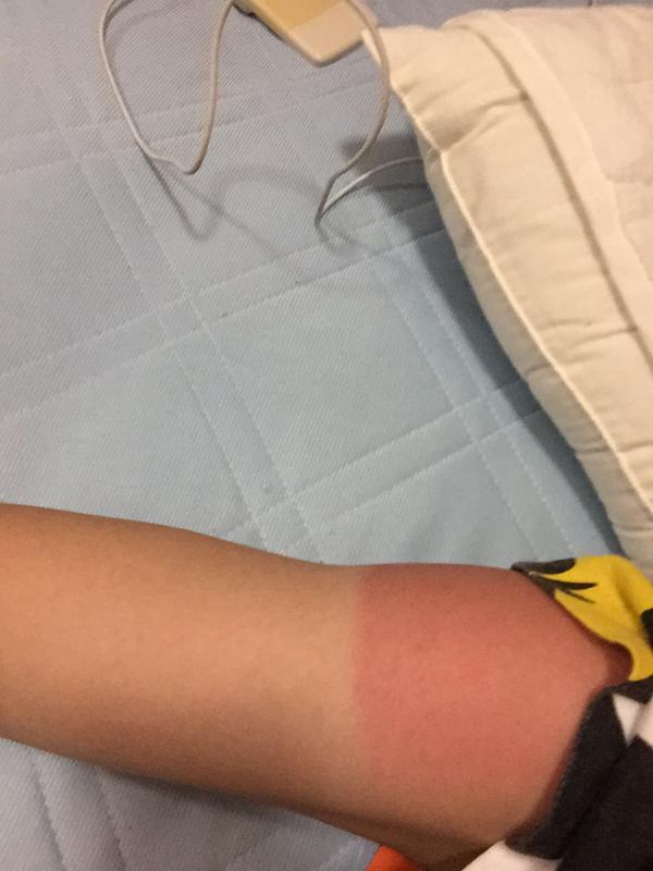 女生扮“弥海砂”一整天 双腿被晒出鱼鳞痕