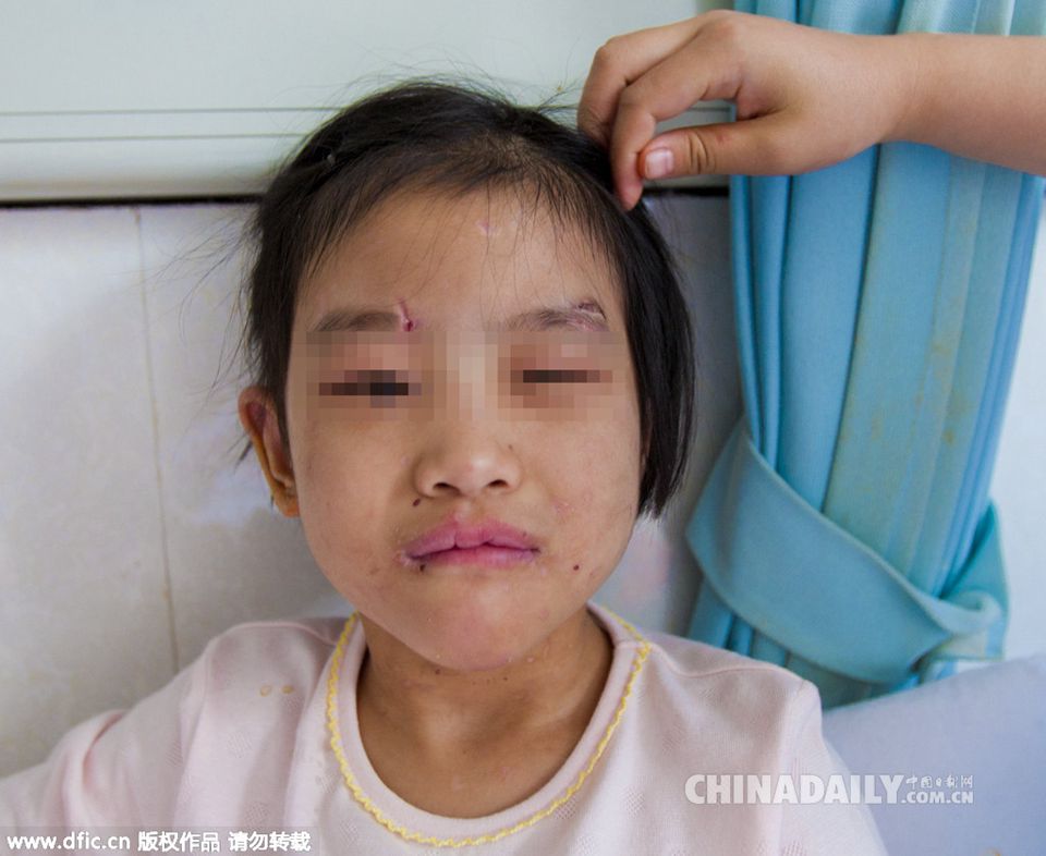 6岁女孩遭后妈虐待 身上无一处完肤