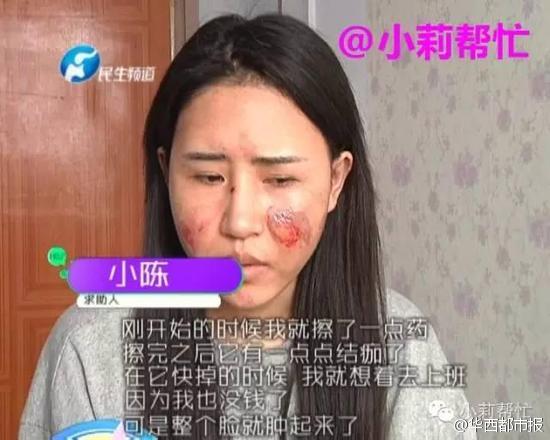 河南女子想喝水懒起床 躺着拿水壶遭烫伤毁容