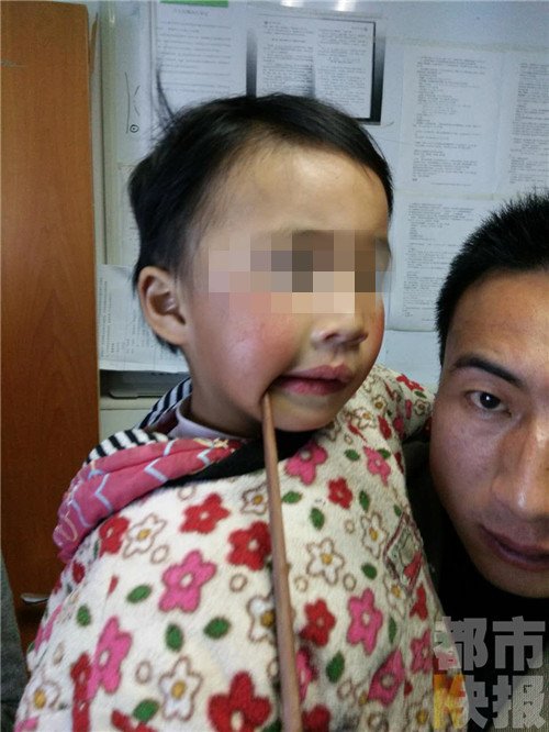 3岁女童摔倒筷子插入嘴 六公分进入头颅
