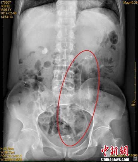 男子体内现导管 长达30多厘米隐藏7年【组图】