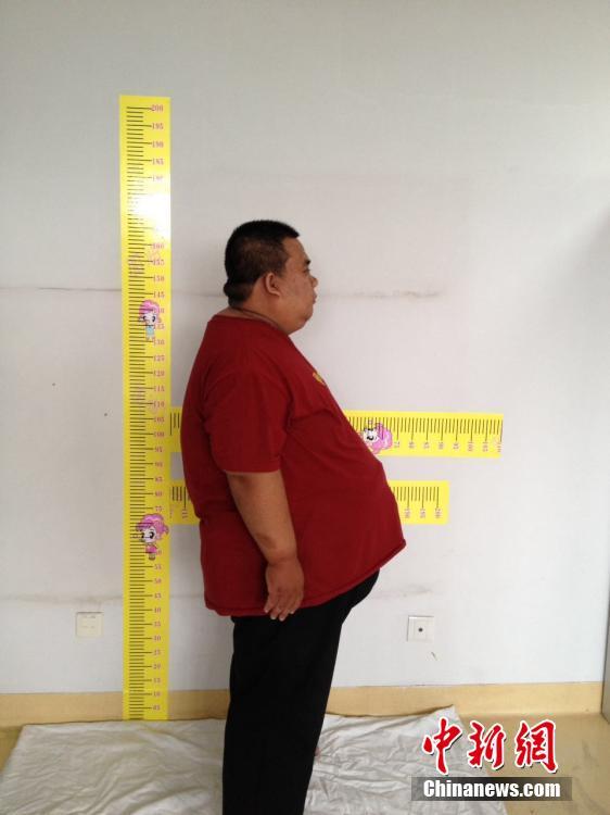 山西344斤重男子缩胃减重 术后想带儿旅行