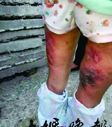 7岁女童疑遭生父后妈虐待 多根手指变形