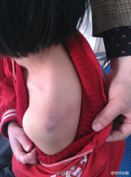 11岁女孩遭母殴打浑身是伤 腿脚淤青肿胀