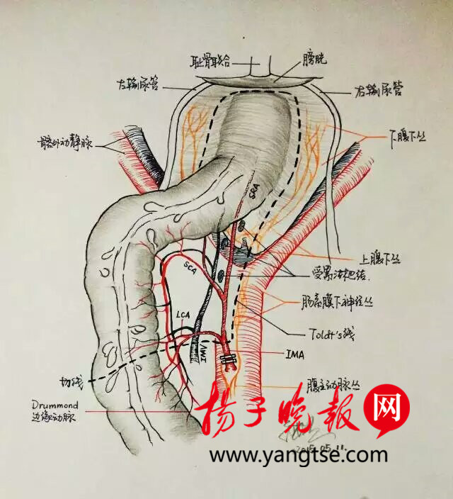 醫生手繪手術解剖圖患者秒懂手術過程